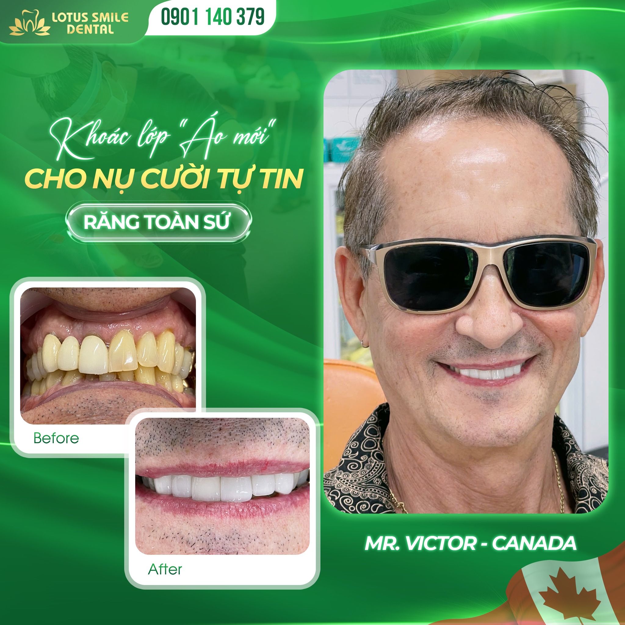 DaNangPorcelaindentalcrowns-BọcrăngsứĐàNẵng(1)