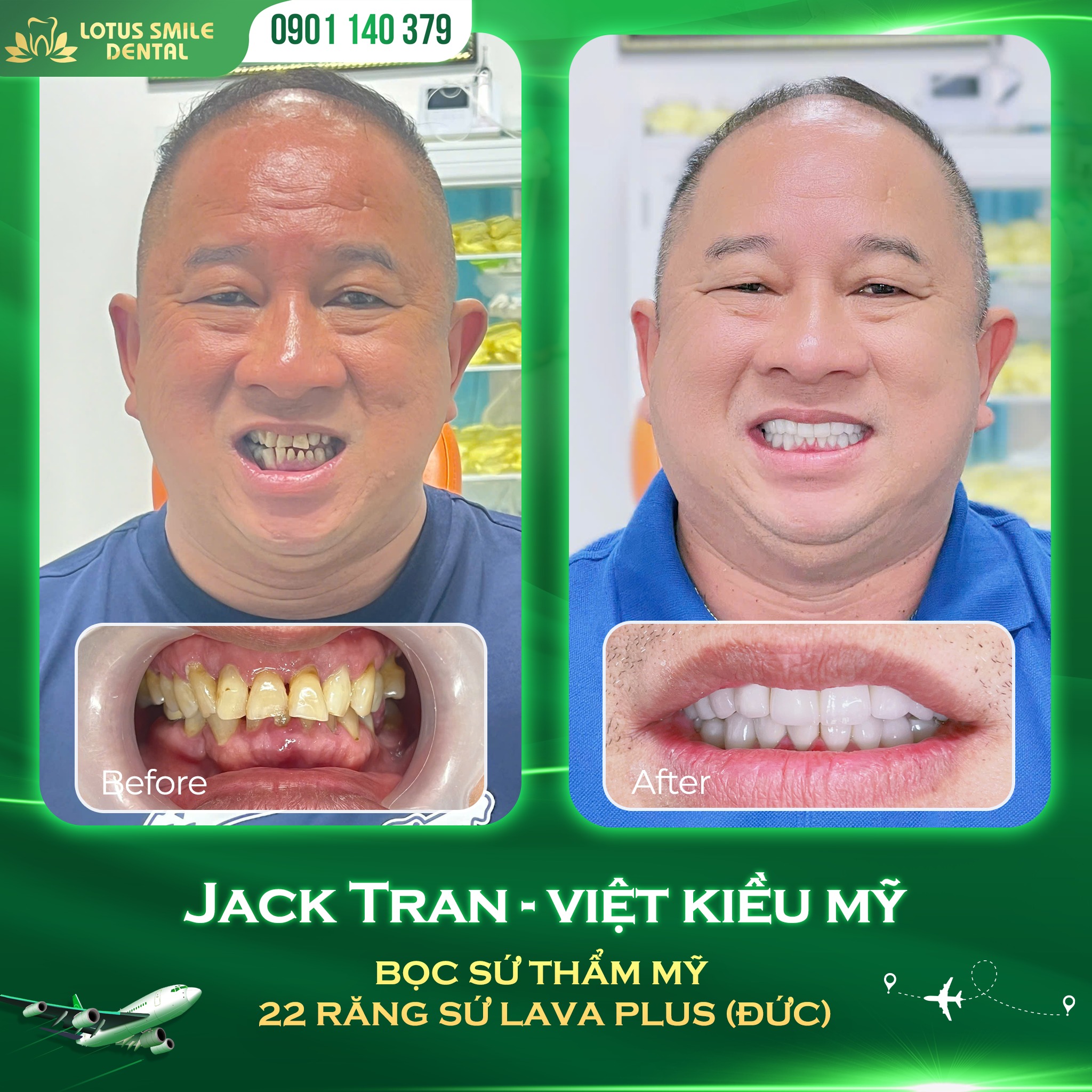 DaNangPorcelaindentalcrowns-BọcrăngsứĐàNẵng(3)