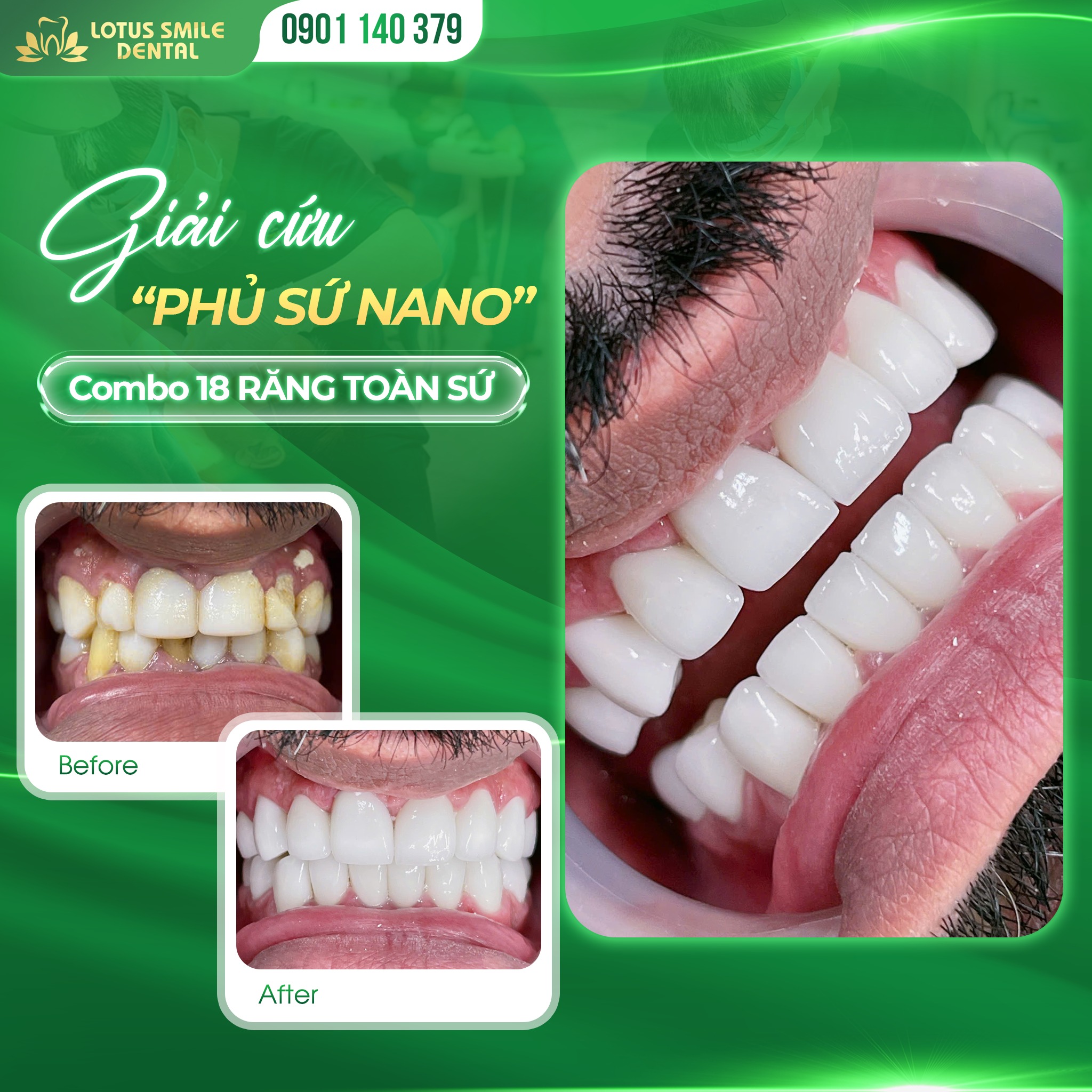 DaNangPorcelaindentalcrowns-BọcrăngsứĐàNẵng(4)