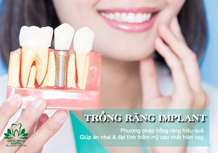 implanttrồngrăng