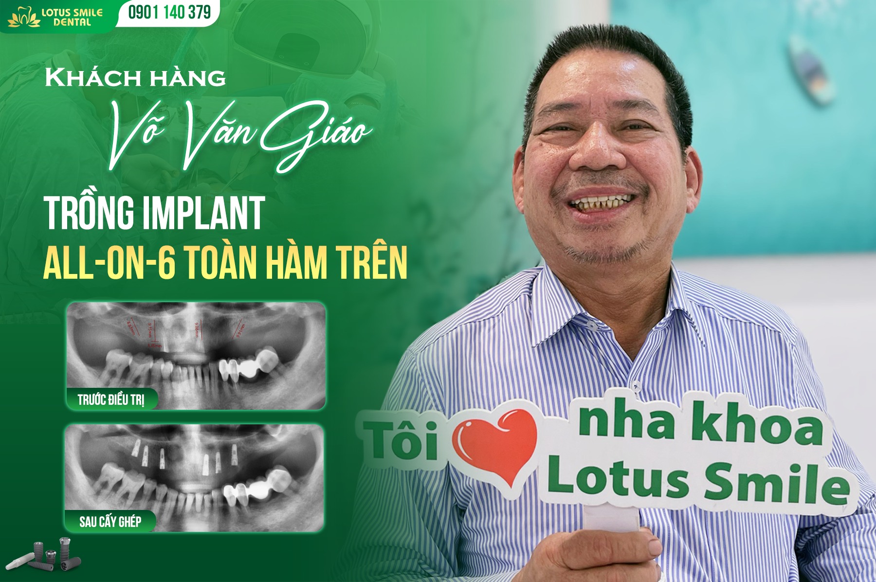 TRỒNGRĂNGIMPLANTTOÀNHÀM