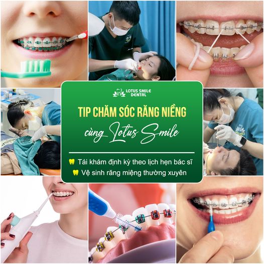 CÁC TIP CHĂM SÓC RĂNG MIỆNG KHI NIỀNG RĂNG