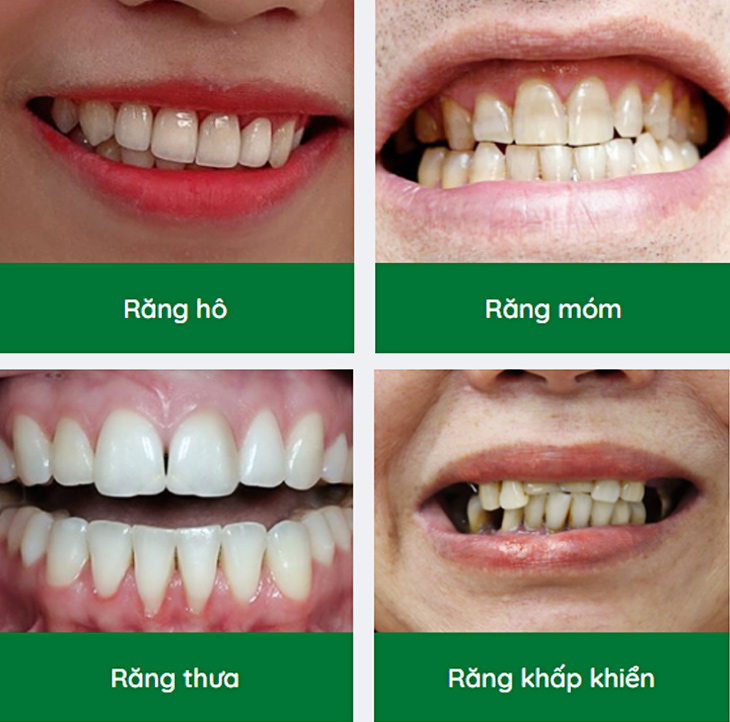 nieng-rang-cong-nghe-cao